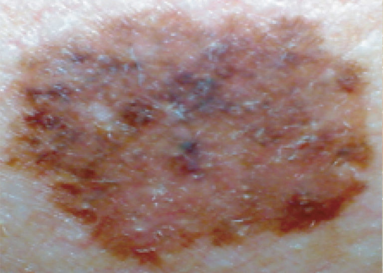 What to look for Australian Melanoma Research Foundation