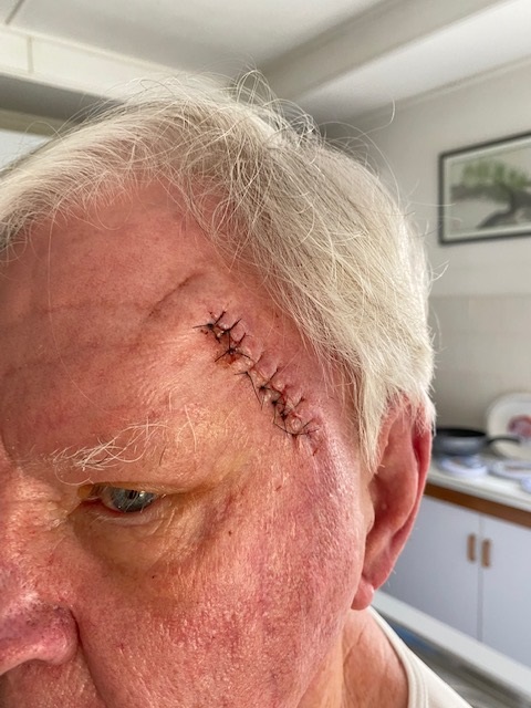 Grahame Pilgrim's melanoma story