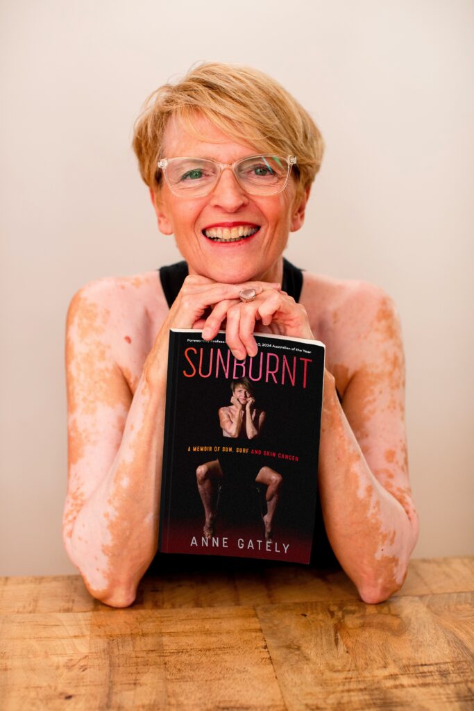 Anne Gately | Sunburnt: a memoir of sun, surf and skin cancer